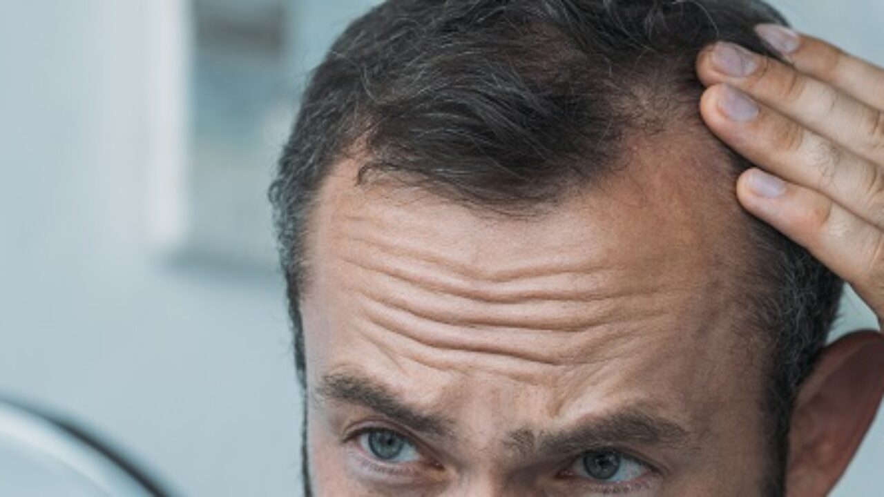 Est-ce que l’alopécie se soigne ?